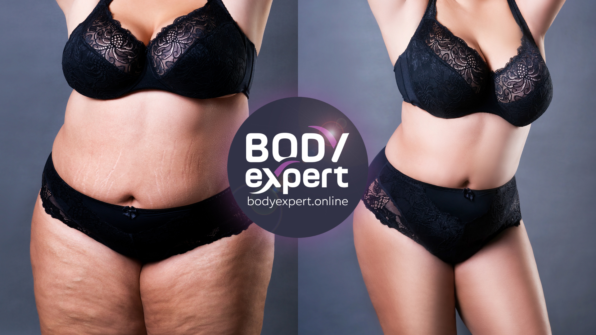Thick and abdominal liposuction : before and after