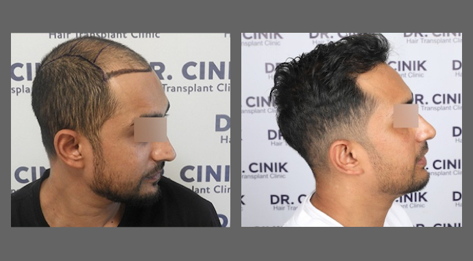 image-avant-apres-greffe-de-cheveux