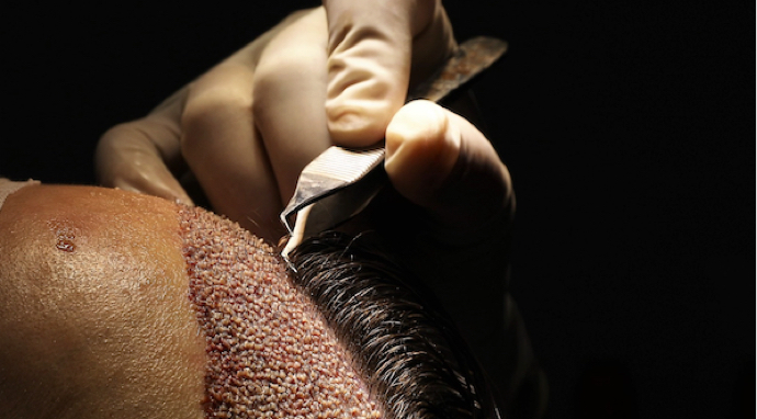 image-densité-capillaire