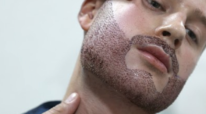 image-etapes-greffe-barbe