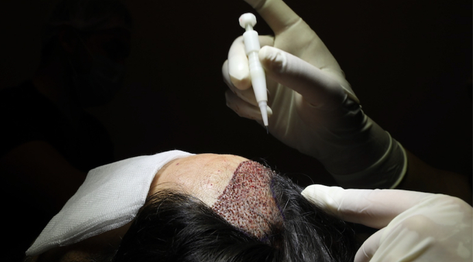 image-extraction et implantation des greffons