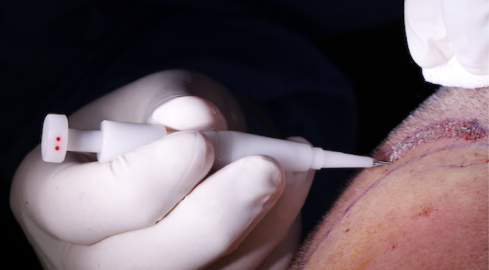 image-greffe-barbe-DHI-rapide-saine