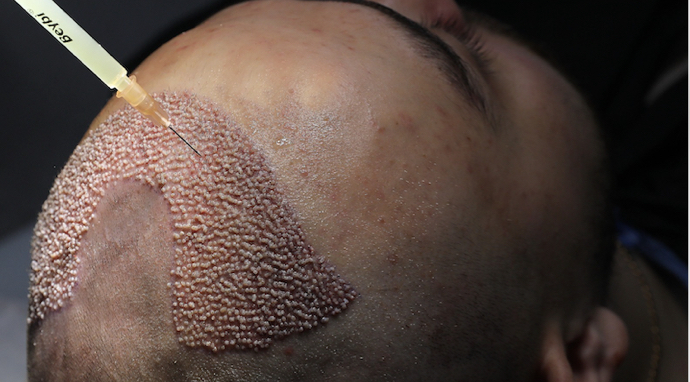 image-greffons-implantés-stylo