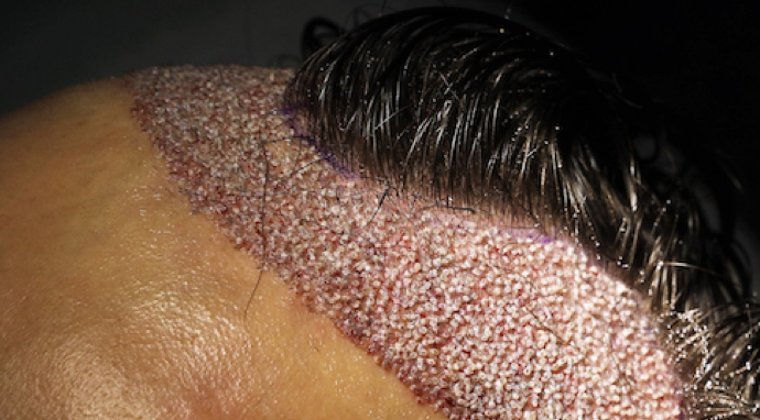 image-greffons-implantés