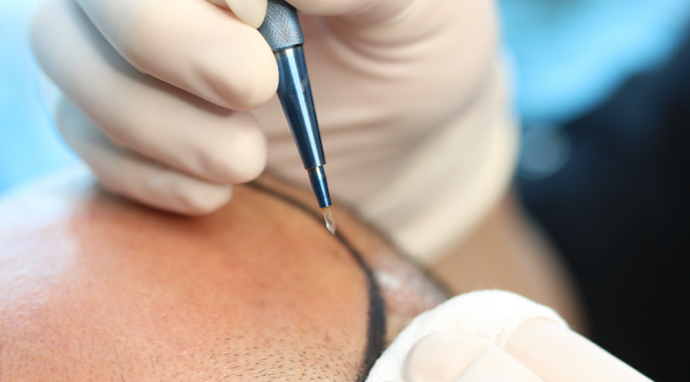 image-implantation-greffons