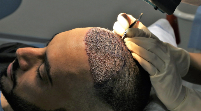 image-implatation-greffons-cheveux