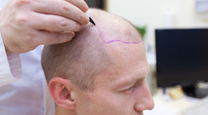 image-marquage-rasage-zones-intervention