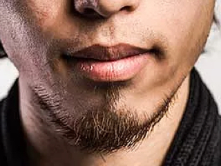 image-pilosité-non-homogene