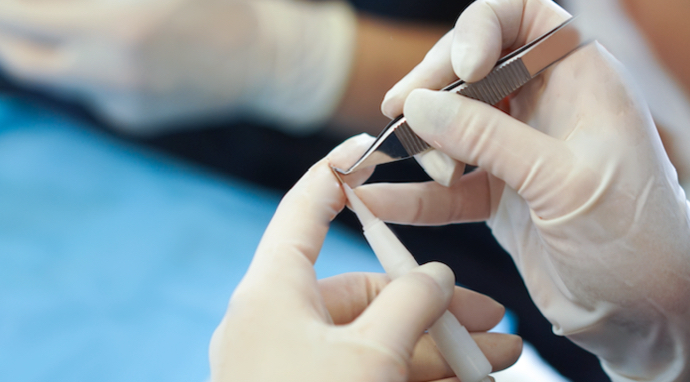 image-stylo-implanteur