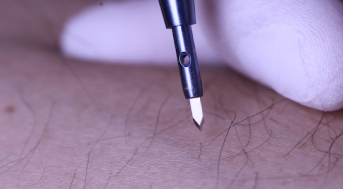 image-technique-implantation-FUE