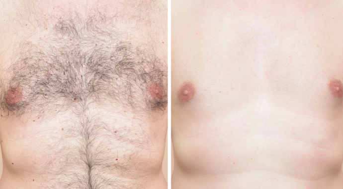 images-autres-greffes-poils