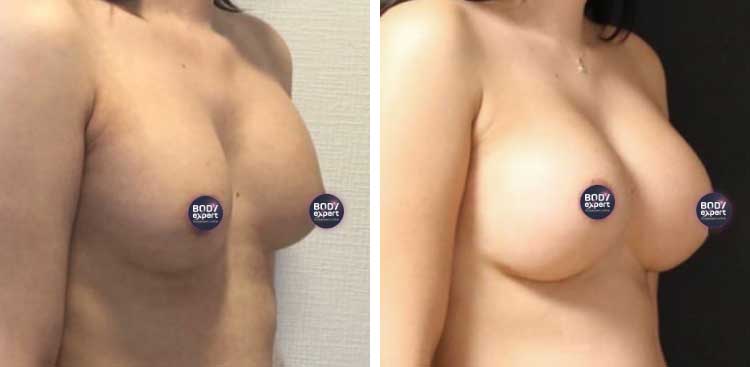 Augmentation mammaire en Turquie : Avant - Après