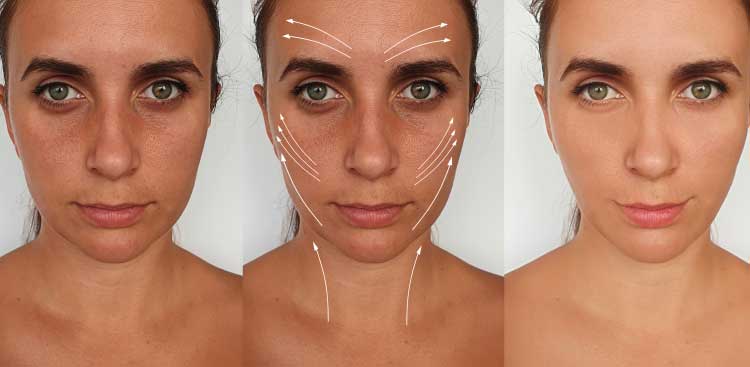 Photos avant après bichectomie + injections botox + soins beauté