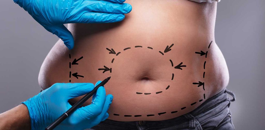 Liposuction in Turkey