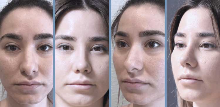 Rhinoplastie en Turquie : Avant - Après FemmeRhinoplastie en Turquie : Avant - Après Femme