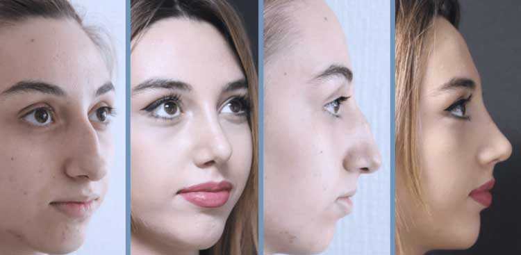 Rhinoplastie en Turquie : Avant - Après FemmeRhinoplastie en Turquie : Avant - Après Femme