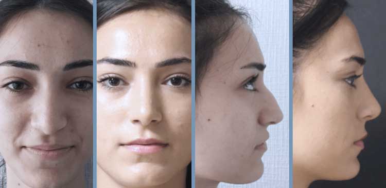 Rhinoplastie en Turquie : Avant - Après FemmeRhinoplastie en Turquie : Avant - Après Femme