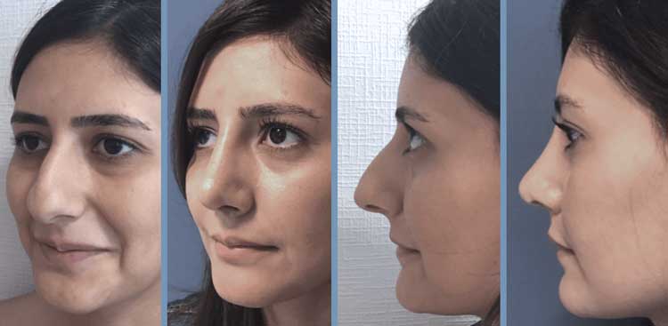 Prix d'une rhinoplastie en france