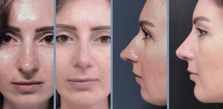 Rhinoplastie en Turquie : Avant - Après FemmeRhinoplastie en Turquie : Avant - Après Femme