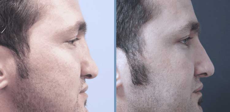 Rhinoplastie en Turquie : Avant - Après FemmeRhinoplastie en Turquie : Avant - Après Homme