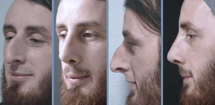 Rhinoplastie en Turquie : Avant - Après FemmeRhinoplastie en Turquie : Avant - Après Homme