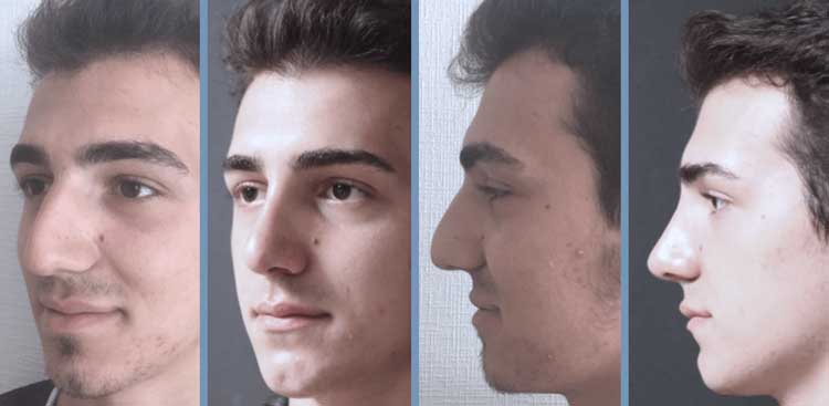 Rhinoplastie en Turquie : Avant - Après FemmeRhinoplastie en Turquie : Avant - Après Homme