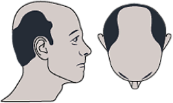 image-alopecie-importante-1