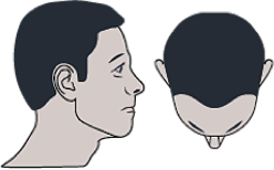 image-alopecie-legere-1