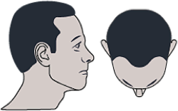 image-alopecie-legere-2