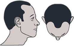 image-alopecie-legere-3