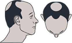 image-alopecie-moyenne-3