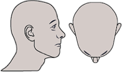 image-alopecie-totale