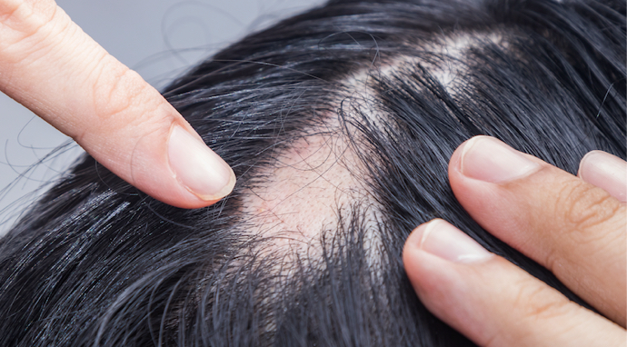 image-calvitie-localisée