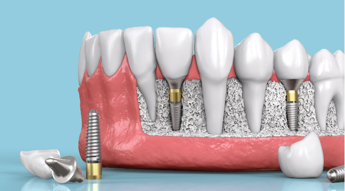 image-comment-poser-implant-dentaire