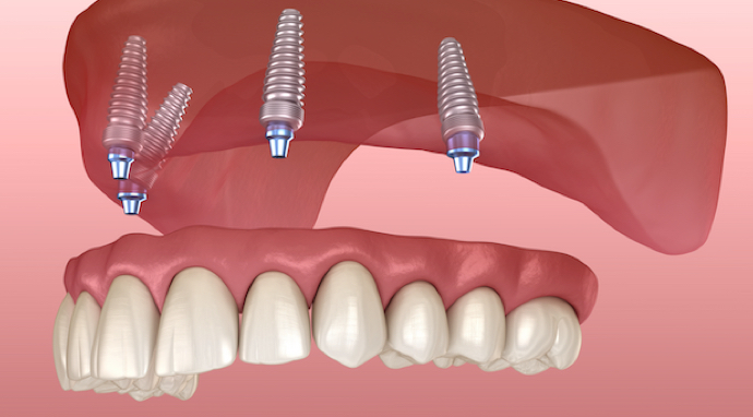 image-dentier-amovible