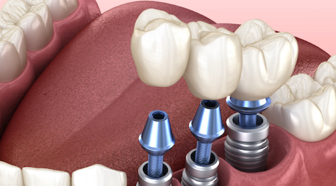 image-differents-types-implants