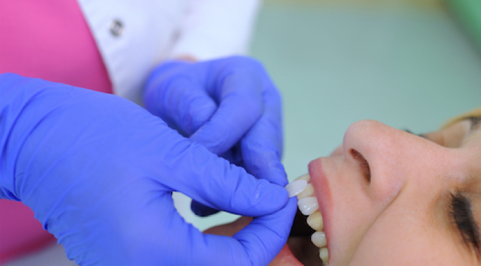 image-etapes-pose-facette-