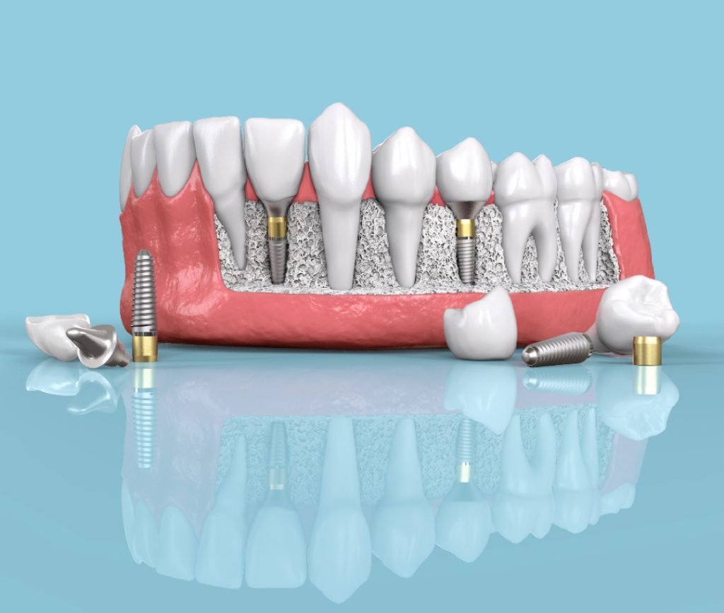 image-expert-soins-dentaire-Istanbul