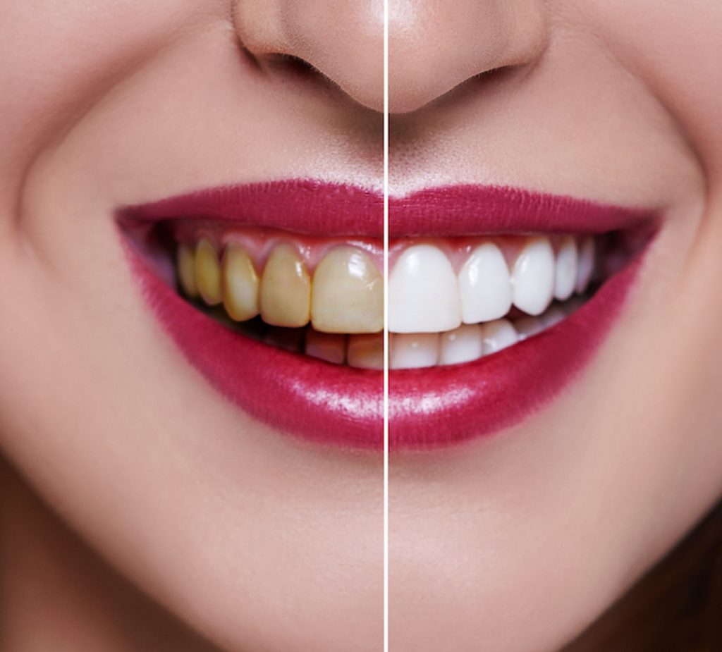 Image-facette-dentaire-Turquie