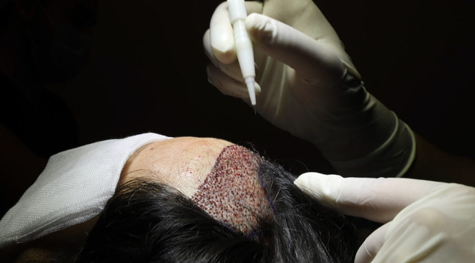 image-greffe-cheveux-femme (2)