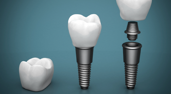 image-implant-dentaire-explication