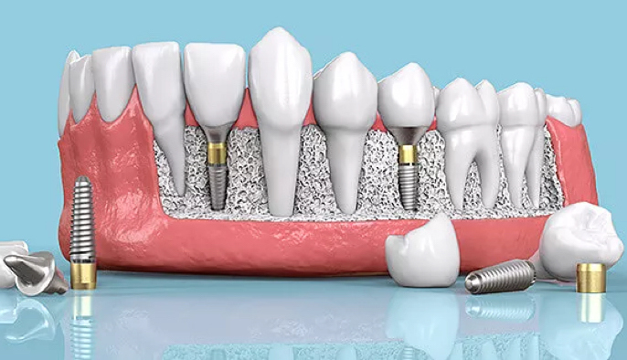 image-Implant-le-guide-comple
