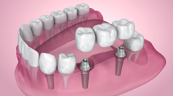 image-implants-dentaires
