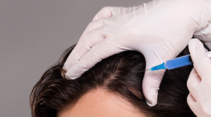 image-mesotherapie-capillaire