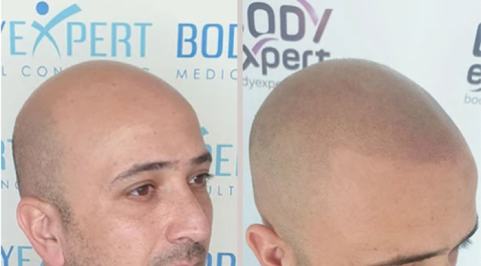image-micropigmentation-style-rasé