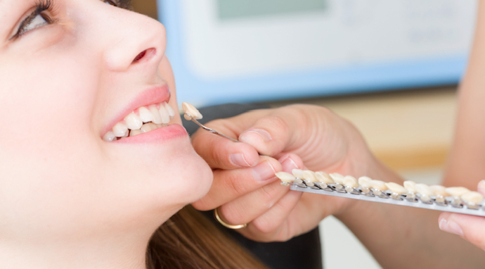 image-opter-facette-dentaire