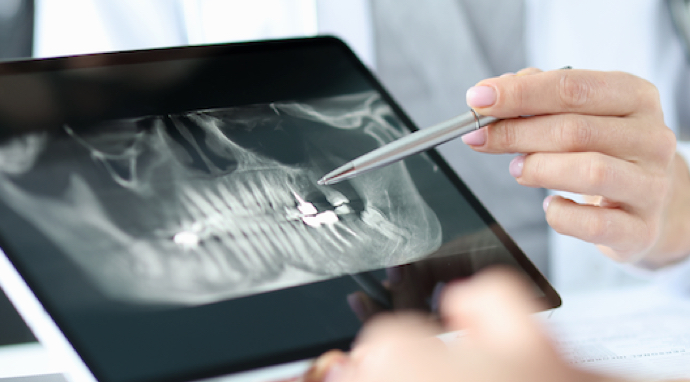 image-prix-implant-dentaire