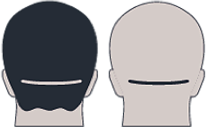 image-reparation-cicatrice-FUT