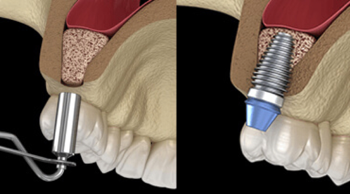 image-Traitement-Sinus-Lift-Body-Expert