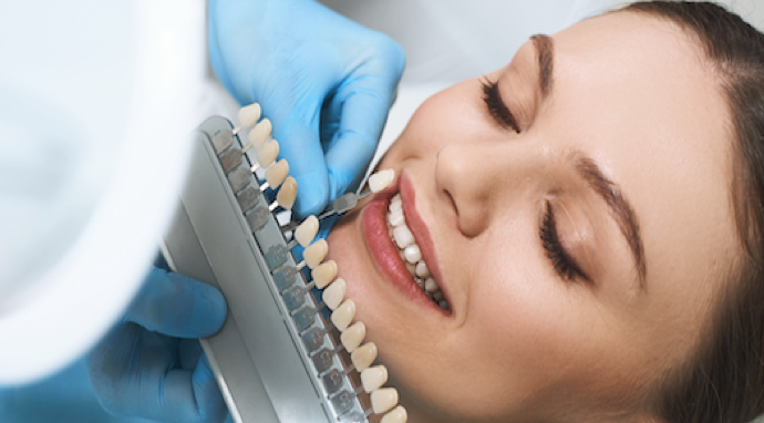 image-type-facette-dentaire-choisir